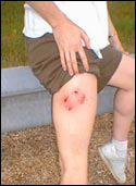 dog bite